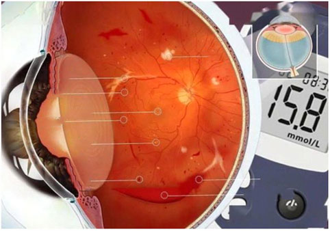 糖尿病视网膜病变（DR）_眼科知识网